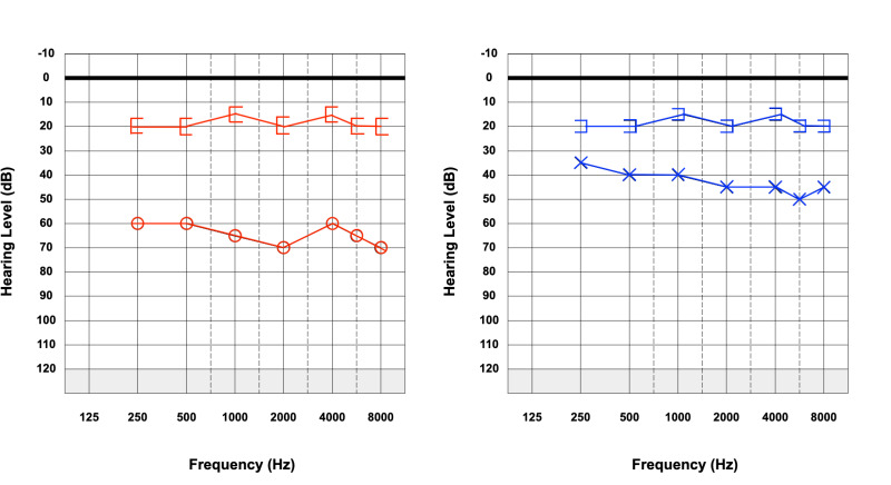 An audiogram chart displays hearing thresholds at various frequencies, illustrating potential hearing loss and the.